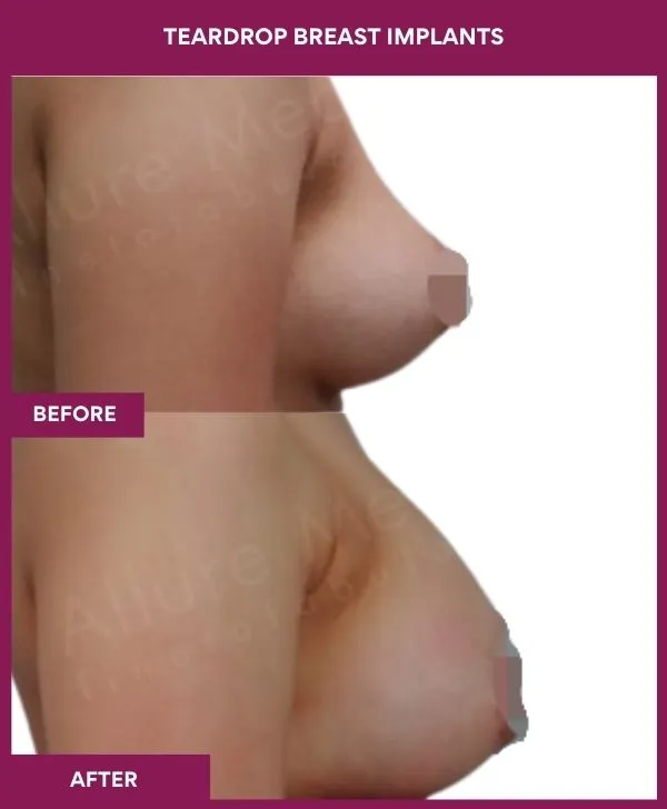 teardrop-breast-implants-before-after-results-mumbai-india-patient03-side-right