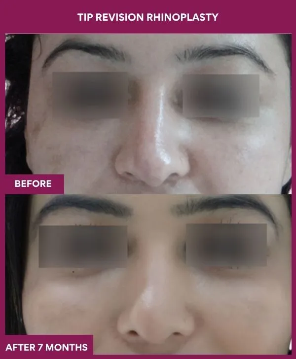 tip-revision-rhinoplasty-surgery-before-after-results-mumbai-india-patient06-front