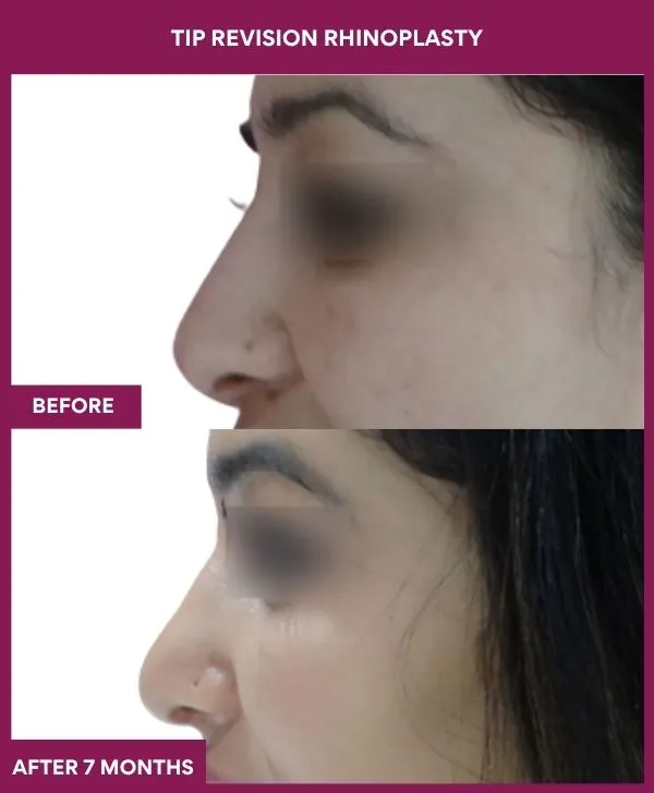 tip-revision-rhinoplasty-surgery-before-after-results-mumbai-india-patient06-side-left