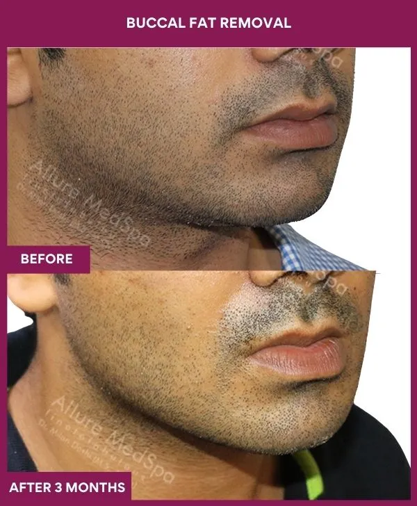 buccal-fat-removal-before-after-results-mumbai-india-patient01-front-right