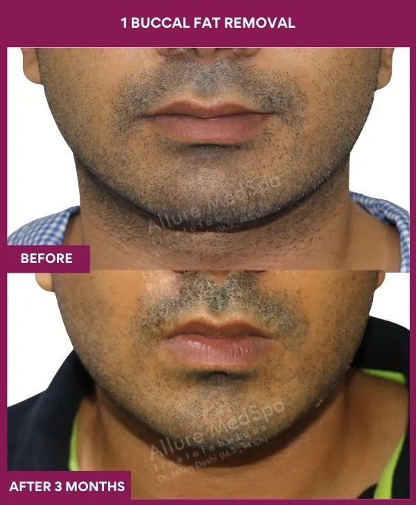 buccal-fat-removal-before-after-results-mumbai-india-patient01-front