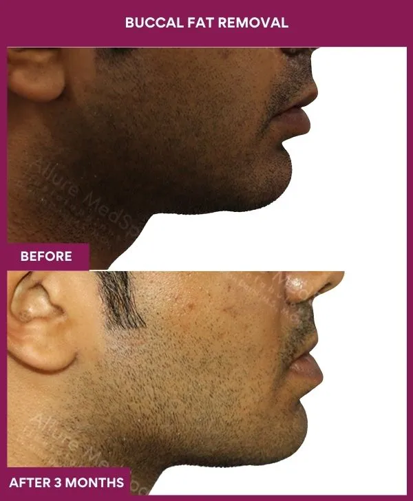 buccal-fat-removal-before-after-results-mumbai-india-patient01-side-right