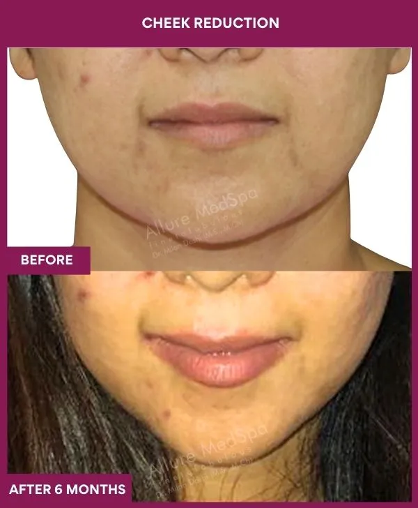 buccal-fat-removal-before-after-results-mumbai-india-patient02-front