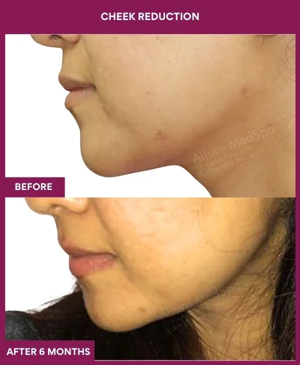buccal-fat-removal-before-after-results-mumbai-india-patient02-side-left