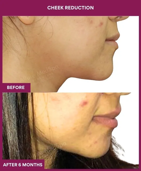 buccal-fat-removal-before-after-results-mumbai-india-patient02-side-right