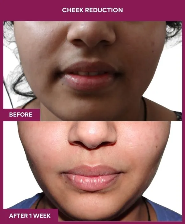 buccal-fat-removal-before-after-results-mumbai-india-patient03-front