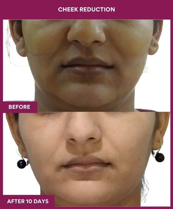 buccal-fat-removal-before-after-results-mumbai-india-patient04-front