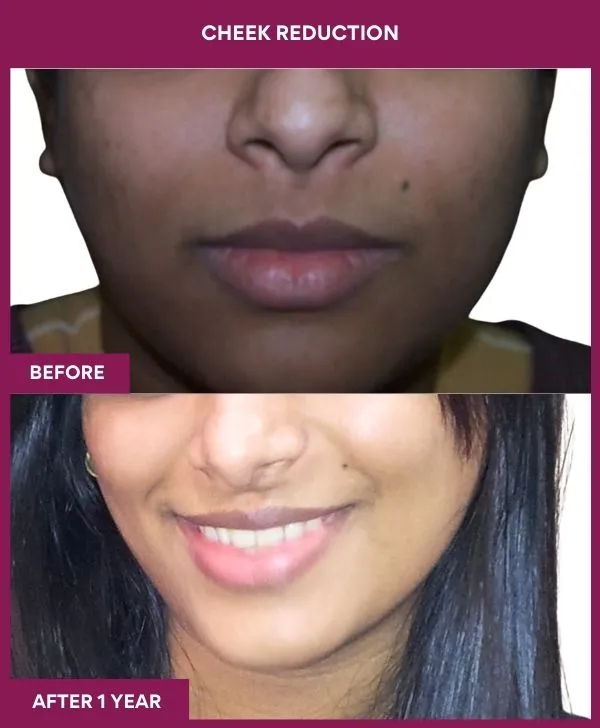 buccal-fat-removal-before-after-results-mumbai-india-patient05-front
