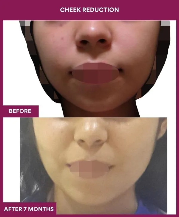 buccal-fat-removal-before-after-results-mumbai-india-patient06-front