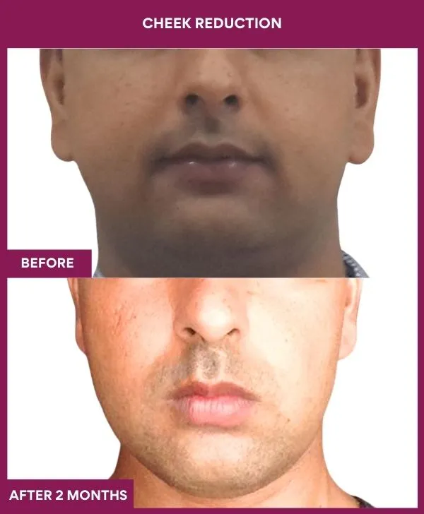 buccal-fat-removal-before-after-results-mumbai-india-patient07-front