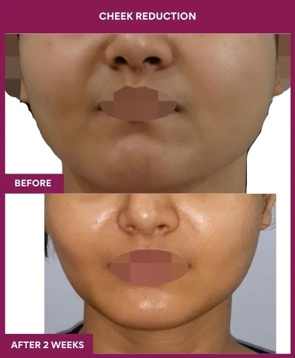 buccal-fat-removal-before-after-results-mumbai-india-patient08-front
