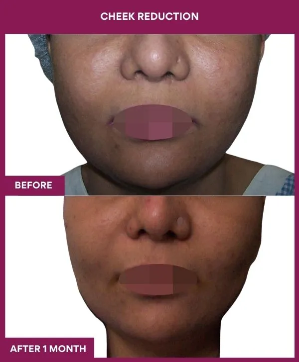 buccal-fat-removal-before-after-results-mumbai-india-patient09-front