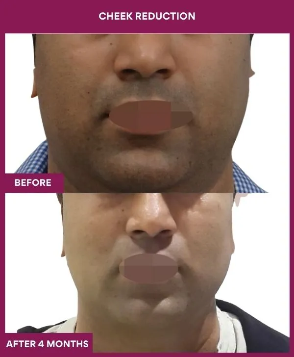 buccal-fat-removal-before-after-results-mumbai-india-patient10-front