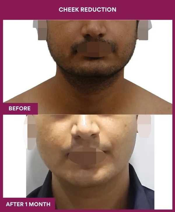 buccal-fat-removal-before-after-results-mumbai-india-patient11-front