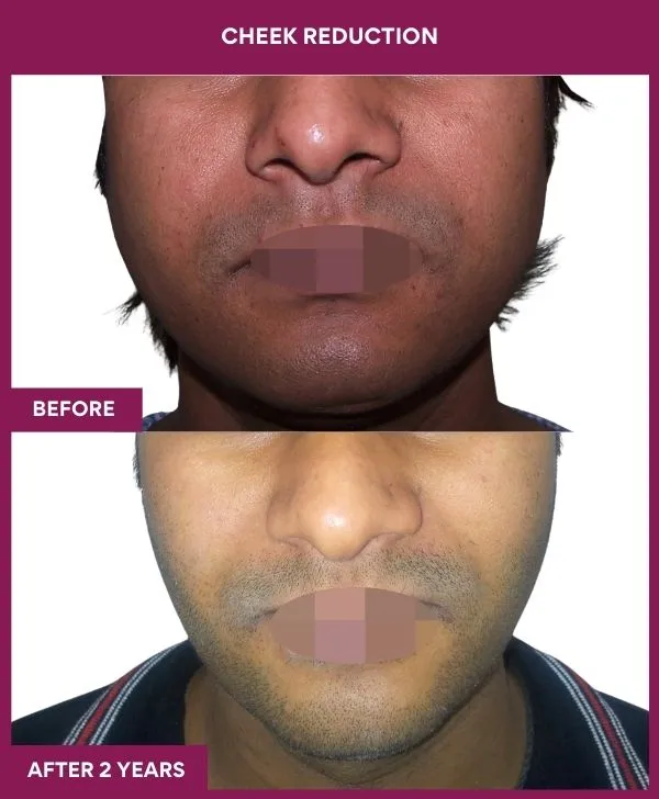 buccal-fat-removal-before-after-results-mumbai-india-patient12-front