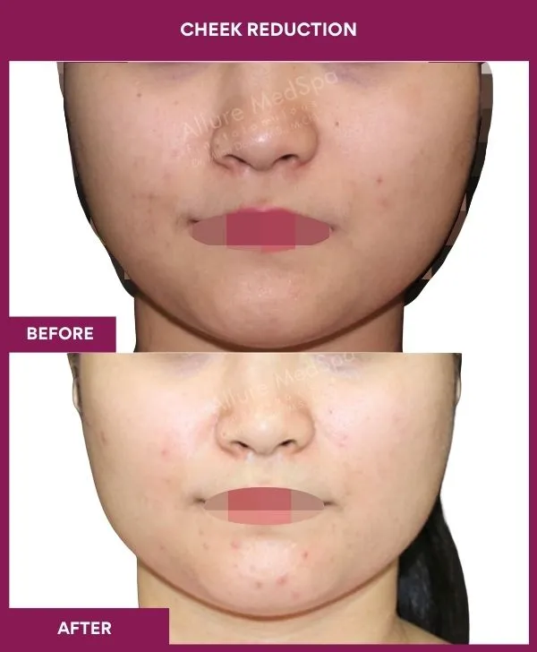 buccal-fat-removal-before-after-results-mumbai-india-patient13-front