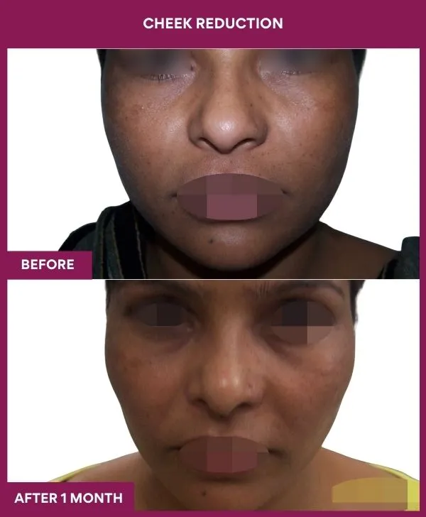 buccal-fat-removal-before-after-results-mumbai-india-patient14-front
