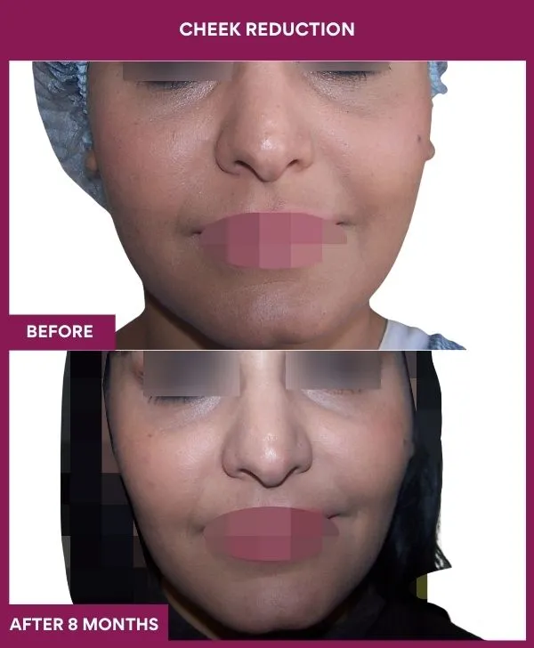 buccal-fat-removal-before-after-results-mumbai-india-patient15-front