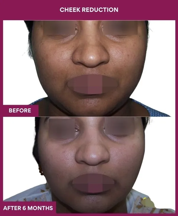 buccal-fat-removal-before-after-results-mumbai-india-patient16-front