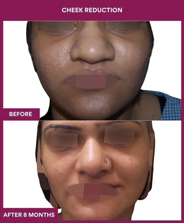 buccal-fat-removal-before-after-results-mumbai-india-patient17-front