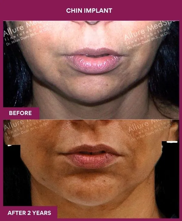 chin-augmentation-surgery-before-after-results-mumbai-india-patient10-front