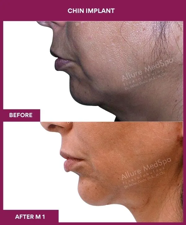 chin-augmentation-surgery-before-after-results-mumbai-india-patient10-side-left
