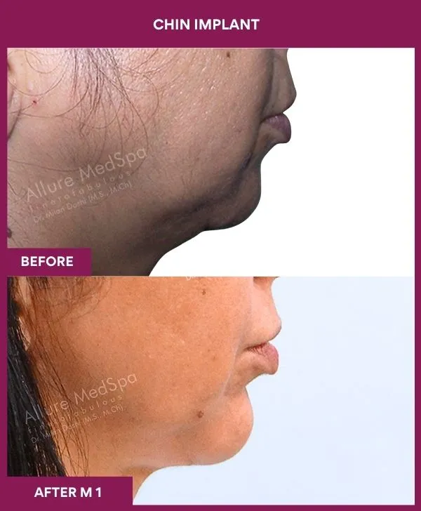 chin-augmentation-surgery-before-after-results-mumbai-india-patient10-side-right