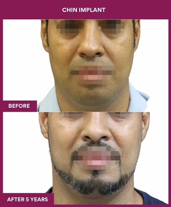 chin-augmentation-surgery-before-after-results-mumbai-india-patient11-front
