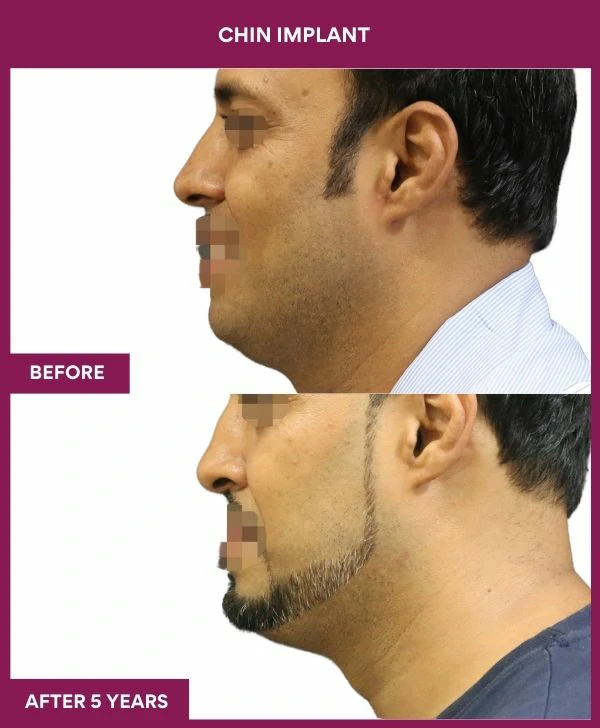 chin-augmentation-surgery-before-after-results-mumbai-india-patient11-side-left