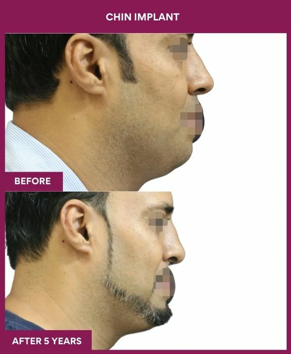 chin-augmentation-surgery-before-after-results-mumbai-india-patient11-side-right