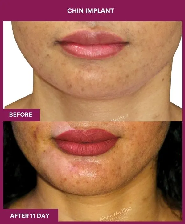 chin-augmentation-surgery-before-after-results-mumbai-india-patient12-front