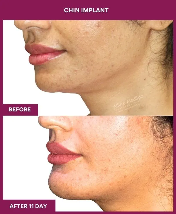 chin-augmentation-surgery-before-after-results-mumbai-india-patient12-side-left