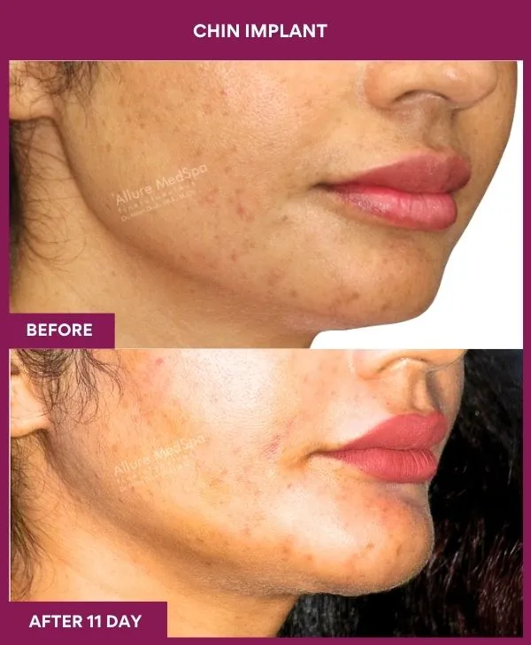 chin-augmentation-surgery-before-after-results-mumbai-india-patient12-side-right