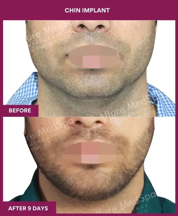 chin-augmentation-surgery-before-after-results-mumbai-india-patient13-front