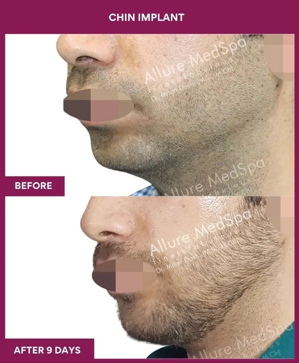 chin-augmentation-surgery-before-after-results-mumbai-india-patient13-side-left