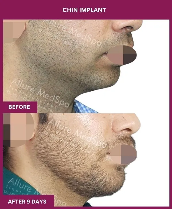 chin-augmentation-surgery-before-after-results-mumbai-india-patient13-side-right