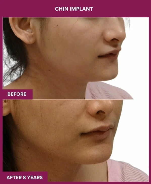 chin-augmentation-surgery-before-after-results-mumbai-india-patient14-front-right