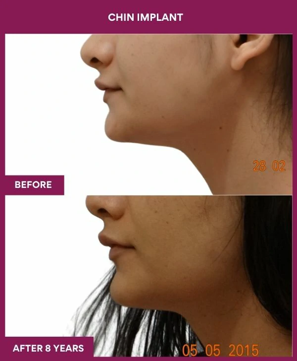 chin-augmentation-surgery-before-after-results-mumbai-india-patient14-side-left