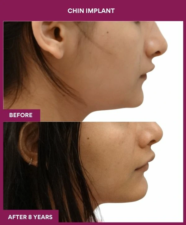 chin-augmentation-surgery-before-after-results-mumbai-india-patient14-side-right