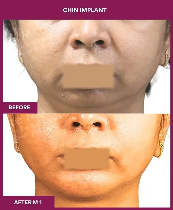 chin-augmentation-surgery-before-after-results-mumbai-india-patient15-front