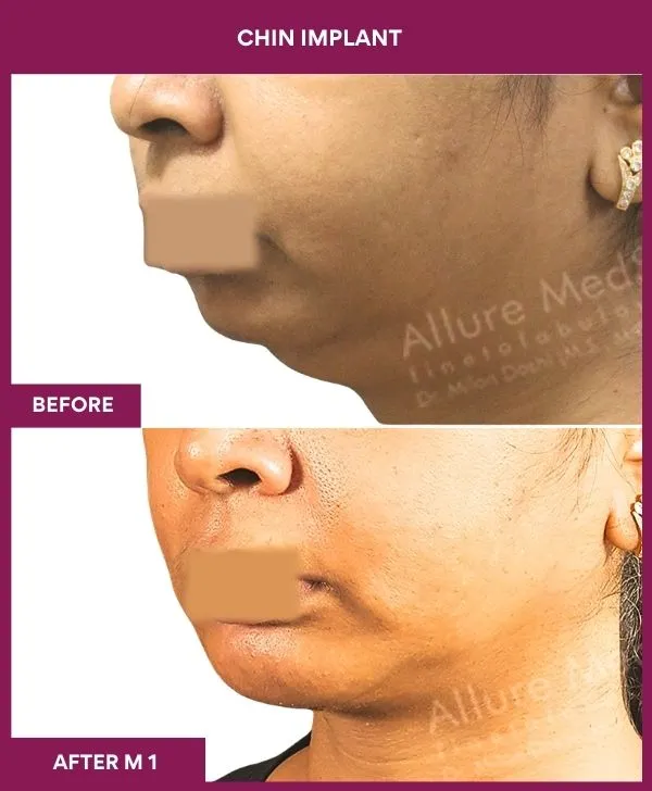 chin-augmentation-surgery-before-after-results-mumbai-india-patient15-side-left