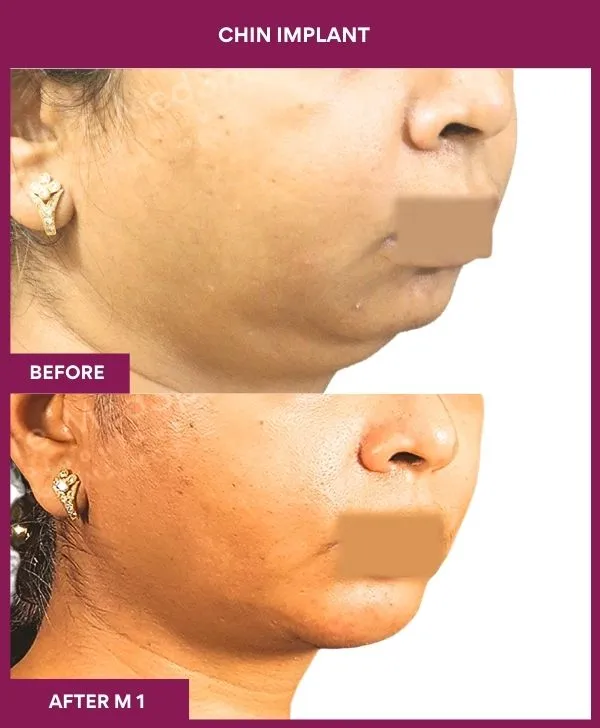 chin-augmentation-surgery-before-after-results-mumbai-india-patient15-side-right