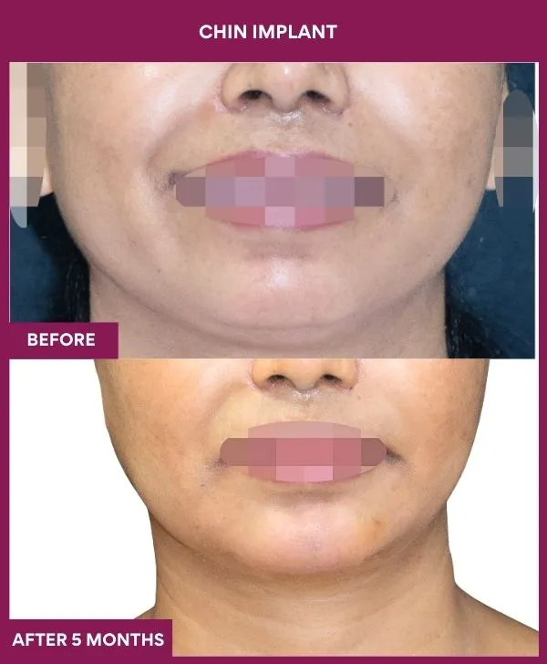 chin-augmentation-surgery-before-after-results-mumbai-india-patient16-front