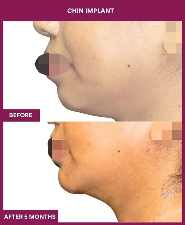 chin-augmentation-surgery-before-after-results-mumbai-india-patient16-side-left