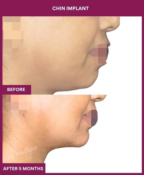 chin-augmentation-surgery-before-after-results-mumbai-india-patient16-side-right