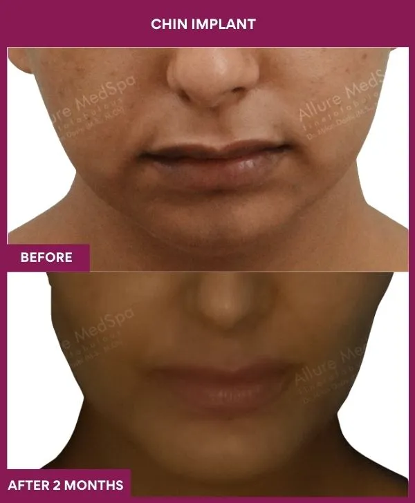 chin-augmentation-surgery-before-after-results-mumbai-india-patient17-front