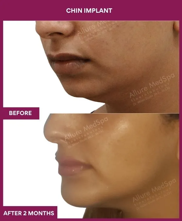 chin-augmentation-surgery-before-after-results-mumbai-india-patient17-side-left