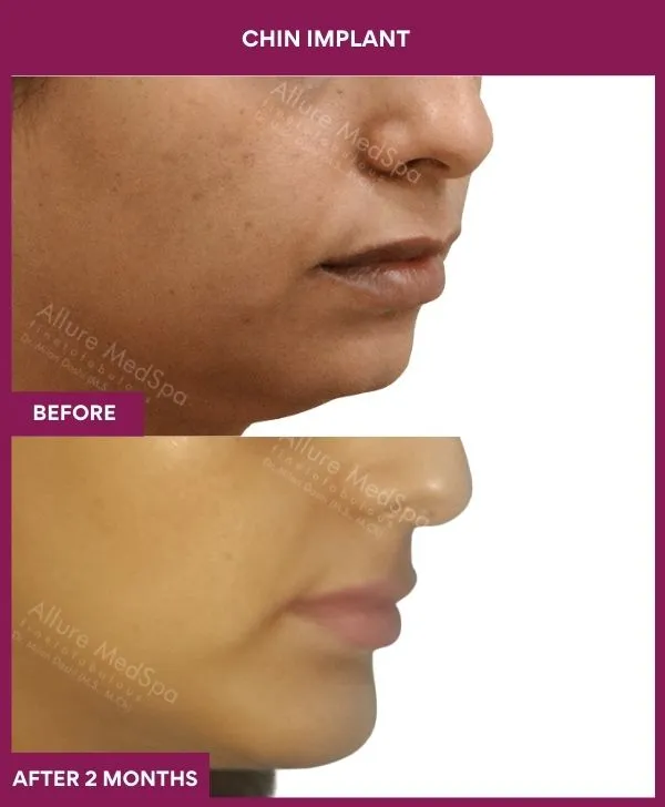 chin-augmentation-surgery-before-after-results-mumbai-india-patient17-side-right