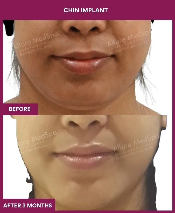 chin-augmentation-surgery-before-after-results-mumbai-india-patient18-front