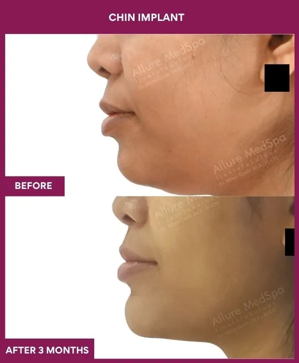 chin-augmentation-surgery-before-after-results-mumbai-india-patient18-side-left